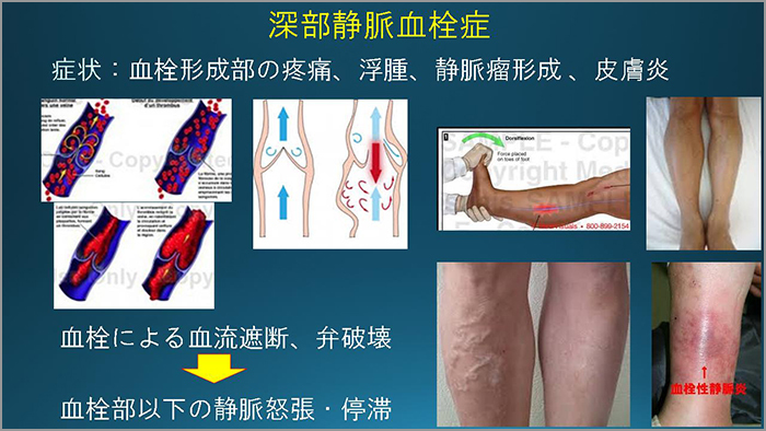 静脈血栓症の症状